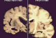 L’apprendimento automatico per l’individuazione dell’Alzheimer