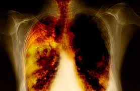 Cancro polmone