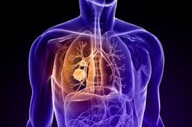 Tumore al polmone: un nuovo farmaco per fermarne la crescita
